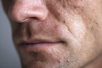 Fototapeta premium Adult Male Acne Close Up with Realistic Facial Skin Texture