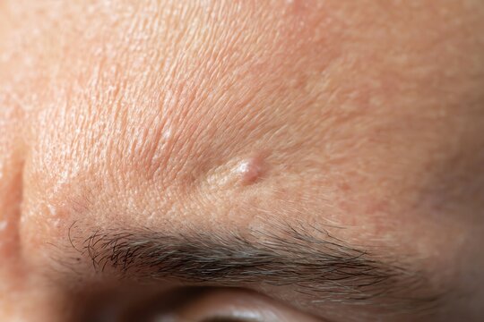 Extreme Close Up of Acne Prone Forehead Skin