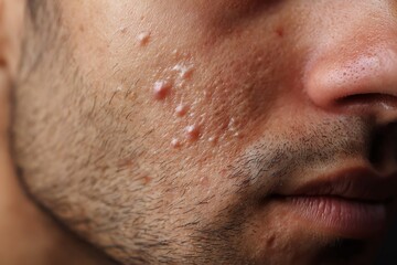 Naklejka premium Facial Acne on Male Skin with Inflamed Pimples and Pores
