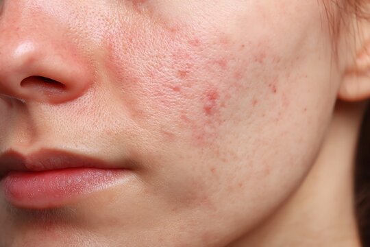 Facial Acne Close Up on Cheek with Mild Inflammation