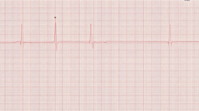 Electrocardiogram Reading: A close-up view of an electrocardiogram (ECG or EKG) tracing on graph paper, displaying the electrical activity of the heart.
