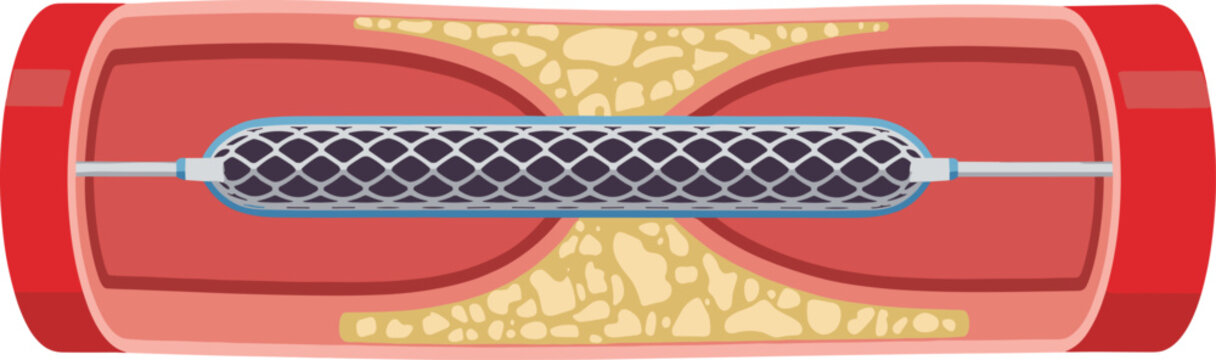 Angioplasty balloon stent opening blocked artery with cholesterol plaque, medical vector illustration of atherosclerosis treatment.