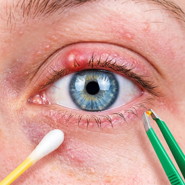 Close-up of human eye with chalazion tweezers