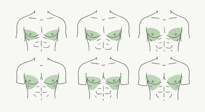 Male chest shape classification diagrams showing anatomical variations of pectoral muscles and torso structures in six line-art sketches with green highlights for medical use.