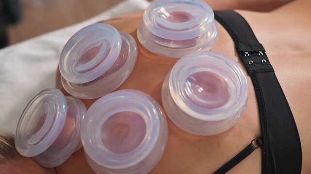 A practitioner applies suction cups on the back of a female client to engage in cupping therapy aimed at muscle recovery