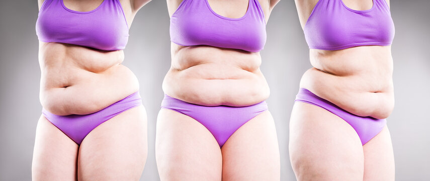 Collage of overweight woman body in purple underwear showing belly fat from different angles. Obesity, weight loss and liposuction concept