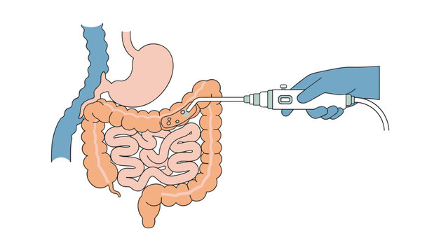 Medical illustration of a colonoscopy procedure showing the camera scope examining the human large intestine.