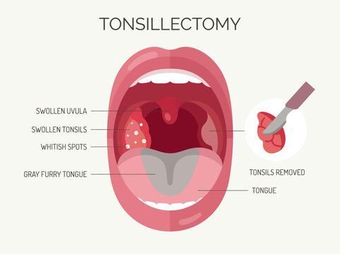 An educational illustration displaying the anatomy relevant to a tonsillectomy procedure, highlighting swollen tissues and surgical tools for clarity and understanding of the process.