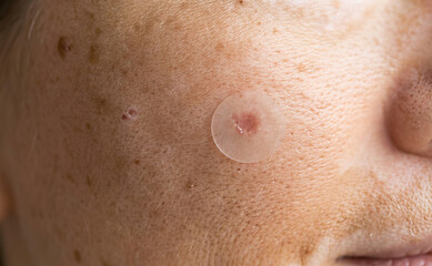 Fototapeta premium Hydrocolloid acne patch on inflamed pimple with freckled skin