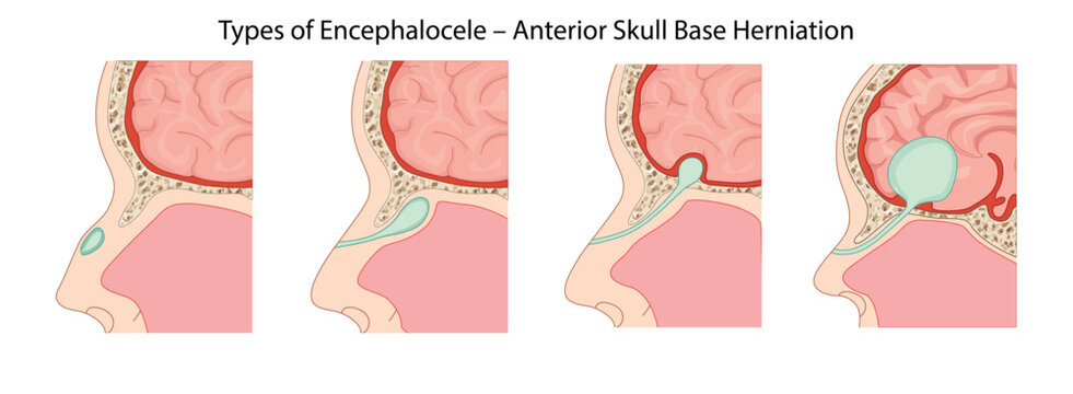 Types of Encephalocele &ndash; Anterior Skull Base Herniation, progressive types of anterior encephalocele with herniation of the meninges and brain tissue through defects in the skull base.