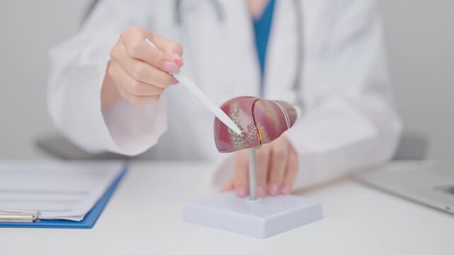 Doctor with human Liver anatomy model. Liver cancer and Tumor, Jaundice, Viral Hepatitis A, B, C, D, E, Cirrhosis, Failure, Enlarged, Hepatic Encephalopathy, Ascites Fluid in Belly and health concept