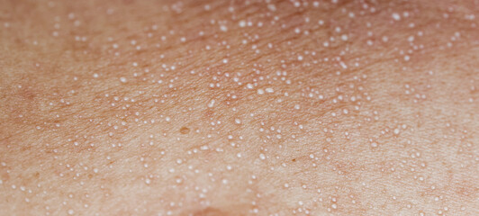 Fototapeta premium Macro close up of sweat droplets on human skin texture, perspiration pores or heat rash condition, medical and wellness concept
