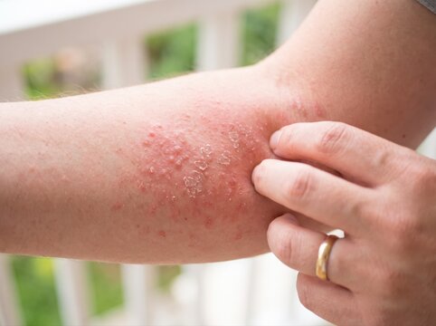 An individual with an itchy, inflamed skin rash with scaling patches on the inner elbow area.