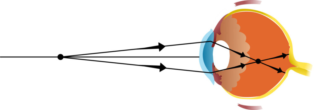 rays focusing in front of the retina, causing blurred distance vision. 