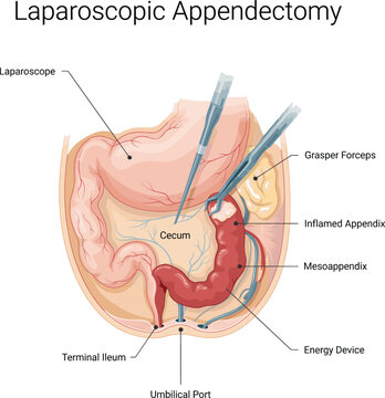 Laparoscopic appendectomy surgery illustration, medical abdominal procedure diagram, inflamed appendix removal healthcare concept, anatomy labeled flat vector illustration