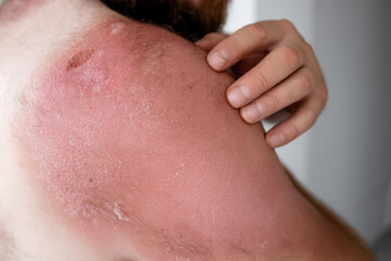Fototapeta premium Side profile of bearded man touching painful sunburnt skin on shoulder, severe sunburn with peeling texture and skin damage after sun exposure