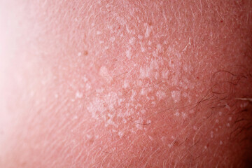 Fototapeta premium Macro close up of skin rash texture with small hypopigmented patches, scaly white spots on red irritated skin, tinea versicolor dermatology concept