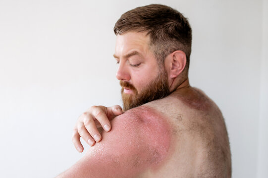 Side profile of bearded man touching painful sunburnt skin on shoulder, severe sunburn with peeling texture and skin damage after sun exposure