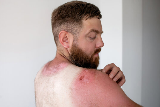 Side profile of bearded man touching painful sunburnt skin on shoulder, severe sunburn with peeling texture and skin damage after sun exposure
