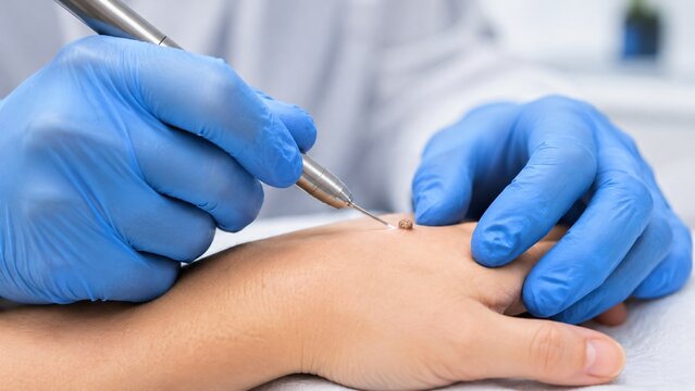 Dermatologist performing skin tag removal procedure on woman hand. Medical professional using cautery tool in clinic. Clinical treatment for skin condition and minor surgical dermatology.