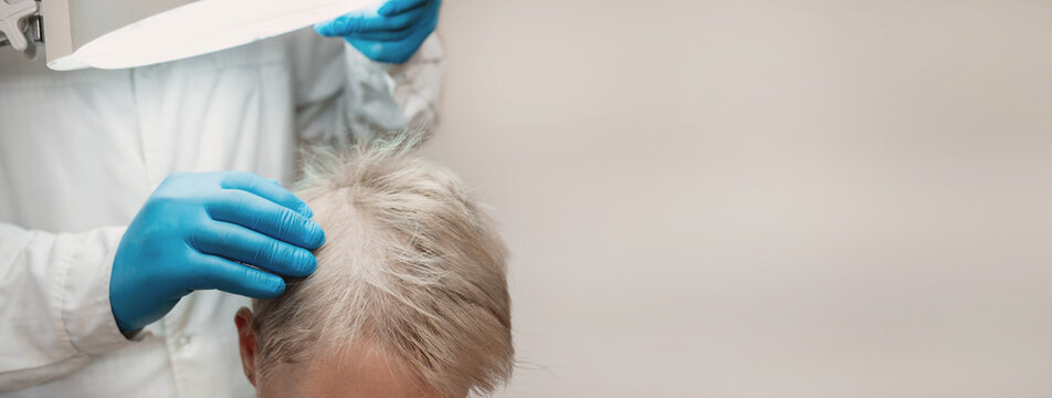 Trichologist examining scalp with magnifying lamp, female patient during hair loss consultation, scalp assessment, dermatology clinic, hair restoration, healthcare, banner copy space