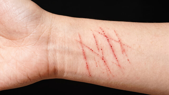 Superficial scratches bleeding on human forearms skin, self-harm wrist cut wound