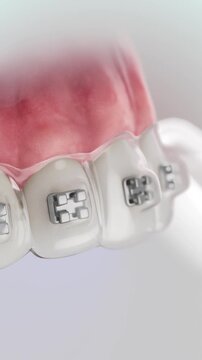 Getting Braces. 3D animation of indirect orthodontic bracket bonding.