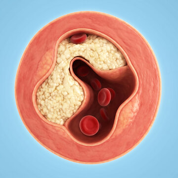 Critical Coronary Artery Stenosis with Calcified Atheromatous Plaque