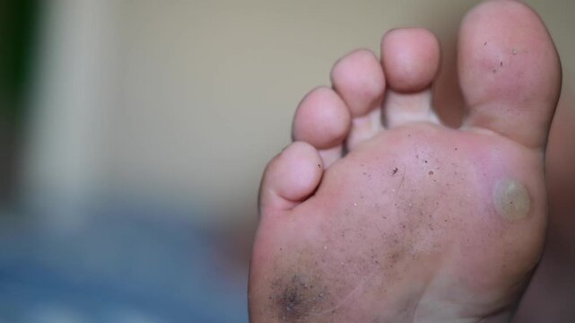 foot close up blister from walking, dirty tired feet, selective focus video, authentic natural light, human problems
