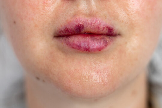 real women's bruised lips after lip augmentation injection of hyaluronic acid close-up, complications and hematomas after a beauty hyaluronan injection on female lips