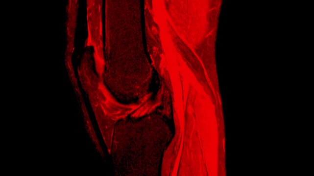 MRI Scan of Right Knee Joint in Red Color Medical Imaging Animation