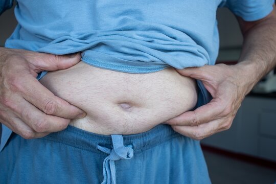 Middle-aged man accumulating abdominal fat due to excessive calorie intake, accumulation of abdominal fat, metabolic disorders, and obesity.