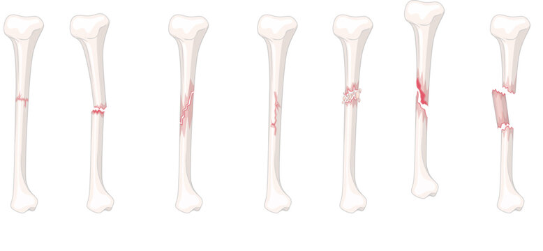 Human Bone Fracture Medical Illustration Set Showing Different Types of Broken Bones