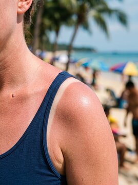 Sunburnt skin with tan line on woman shoulder