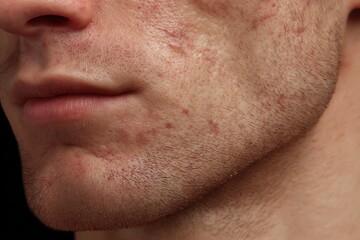 Fototapeta premium Male Hormonal Acne Concept Around Jaw and Chin Area
