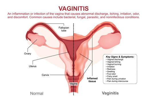 Vaginitis, Vaginal Infection Flashcard Illustration