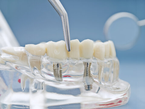 Dental implantology concept. Tweezers placing a ceramic dental bridge on titanium screw implants in a transparent jaw model.