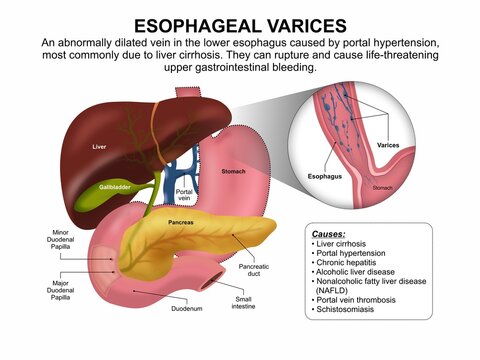 Esophageal Varices, Educational Flashcard Illustration