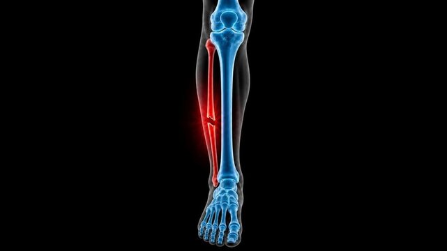 Medical 3D animation showing a fibula bone fracture in the human lower leg