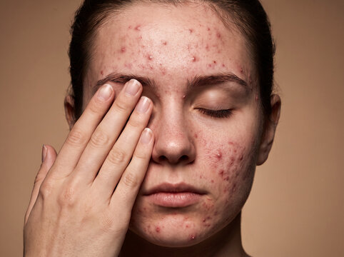 Close up of a sad young woman covering her face with severe acne prone skin
