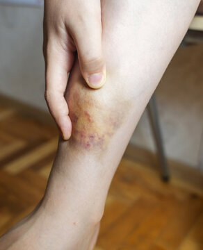 Close up of a large colorful bruise and hematoma on a ten year old boy leg. Child touching painful skin injury on calf after accident, medical healthcare concept.
