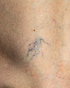 Blurry blue ink mark on human skin