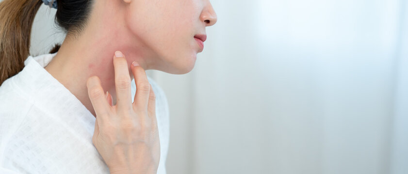skin problem and beauty. woman scratch body has itchy skin from skin allergic, steroid allergy, sensitive skin, red from sunburn, chemical allergy, rash, insect bites, Seborrheic Dermatitis.