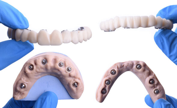 Full jaw dental prosthesis treatment using dental implants and jaw surgery. All-on-four implant therapy for treating total edentulism.