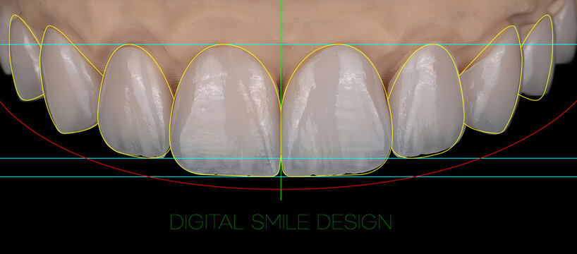 Computer-aided design of porcelain dental veneers in aesthetic dentistry. Digital Smile Design (DSD), computer-designed aesthetic dental applications, zirconium, and glass-ceramic porcelain laminates.