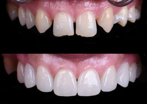 Dental smile design and Hollywood smile. Aesthetic treatment of crooked and deformed teeth using porcelain veneers, aesthetic fillings, and zirconium crowns.