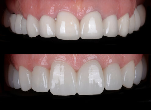 Dental smile design and Hollywood smile. Aesthetic treatment of crooked and deformed teeth using porcelain veneers, aesthetic fillings, and zirconium crowns.