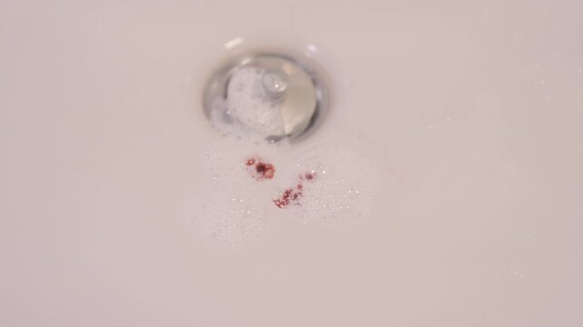 A washbasin containing a few drops of blood mixed with toothpaste foam indicating oral health issues, such as gum or dental disease.