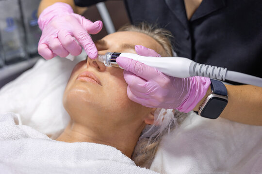 Professional hydradermabrasion treatment targeting the nose and T-zone using a vacuum facial device. Deep pore cleansing, exfoliation and skin rejuvenation performed by a cosmetologist.