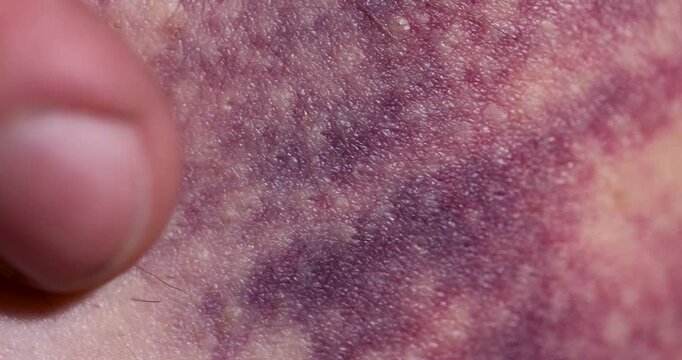 A purple spot is a hematoma on the body, a traumatic hematoma is localized on the damaged skin during its healing